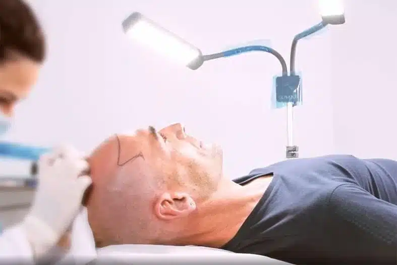 tricopigmentazione
