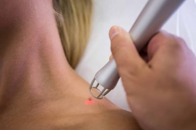 trattamento laser macchie viso